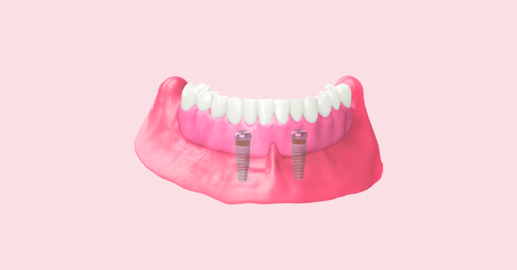 Implant-Retained Dentures | Pur Dental Center | Pointe-Claire