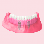 Implant-Retained Dentures