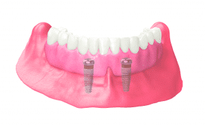 locator scene with denture in place