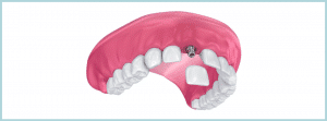 implant222