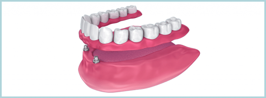 implant retained denture