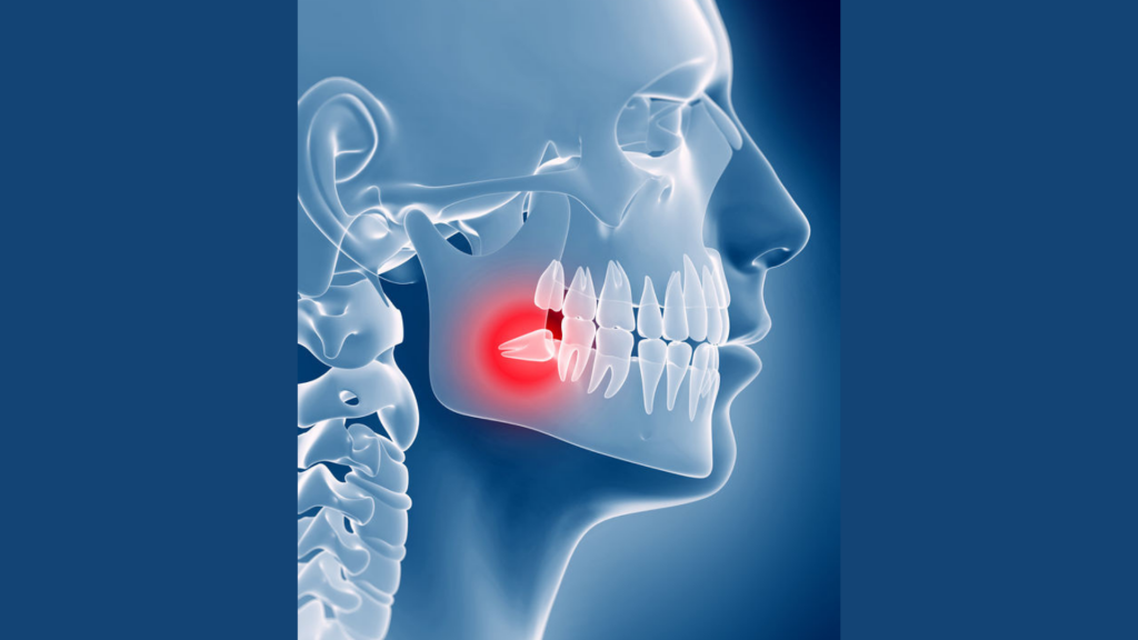 xray of impacted wisdom tooth