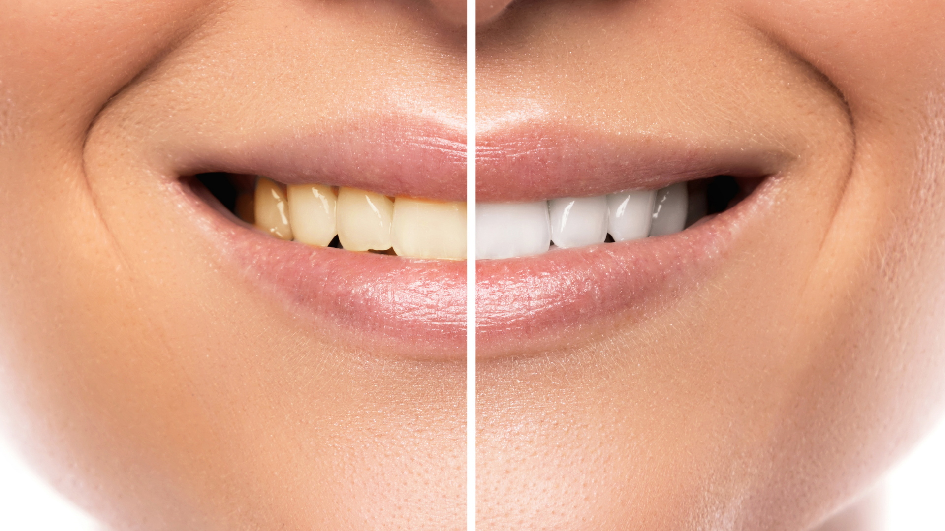 An Intro to Teeth Whitening