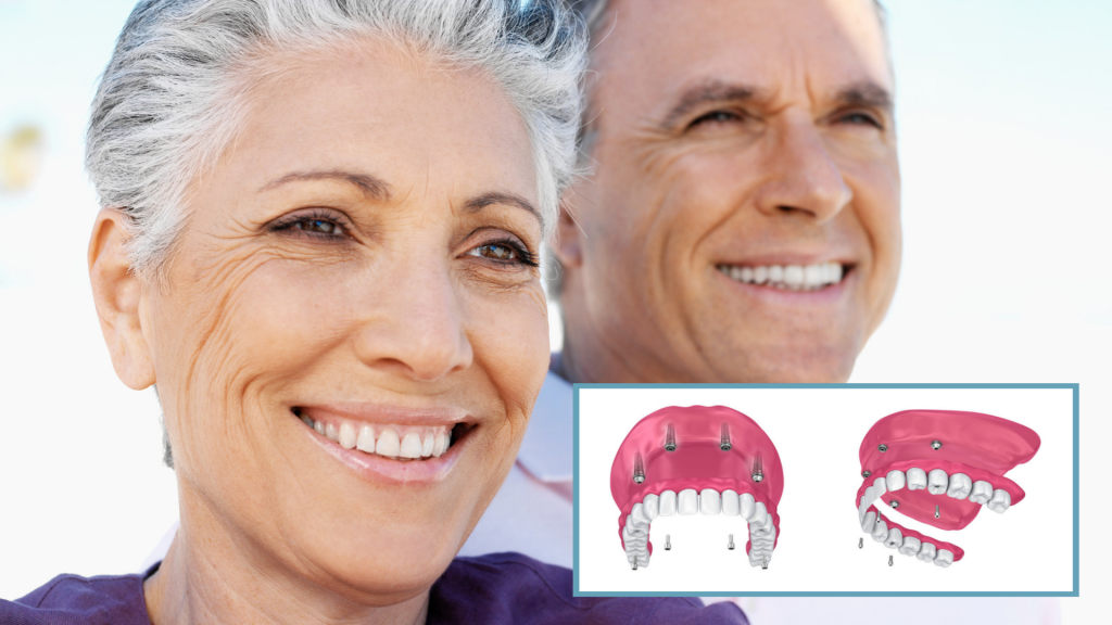 All-on-Implants: Restoring Your Quality of Life | Pur Dental