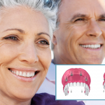 All-on-Implants: Restoring Your Quality of Life