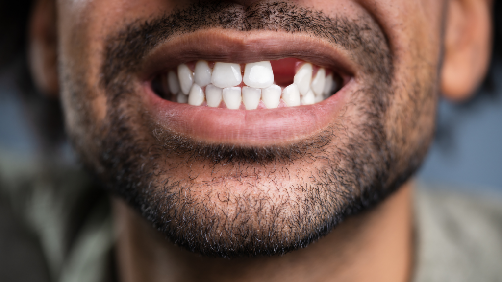 Tooth Tips | Don't Wait to Replace a Missing Tooth | Pur Dental Center