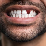 Conseils dentaires | N’attendez pas pour remplacer une dent manquante